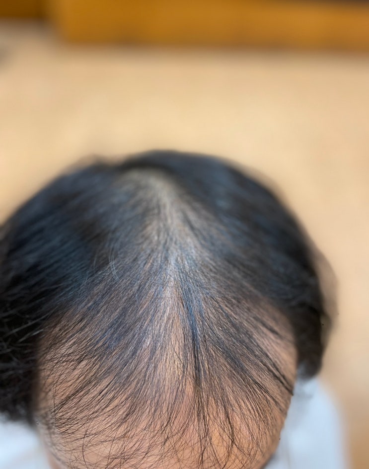  [포항에서여기까지]“탈모·두피·염색… 도대체 뭘 먼저 해야 할까요?” 고민이 많을수록 답은 하나! 부산 사상 르네시떼미용실 토탈탈모성형펌으로 한 번에 해결