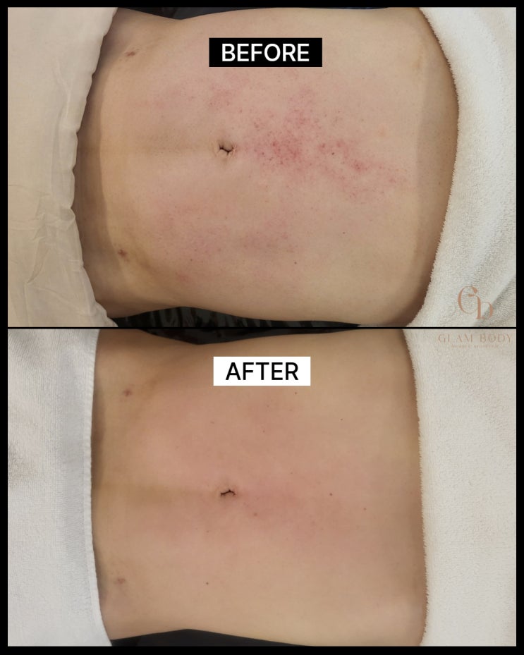  복부 지방흡입 후관리, 왜 다들 받는 걸까요? 붓기와 바본이 가장 심한 시기