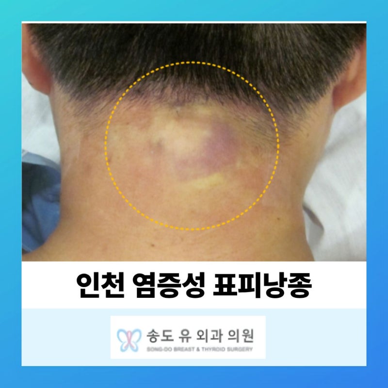 인천 염증성 표피낭종 수술 및 주의사항