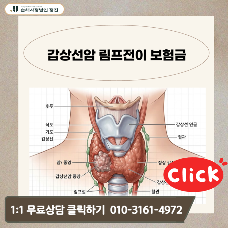  갑상선암 림프전이 보험금, 10%만 받으셨나요? 전액 수령을 위한 실전 대응 전략