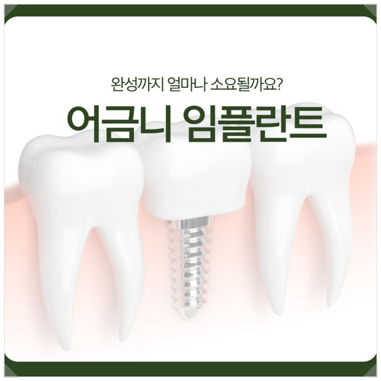  어금니 임플란트, 완성까지 얼마나 소요될까요?