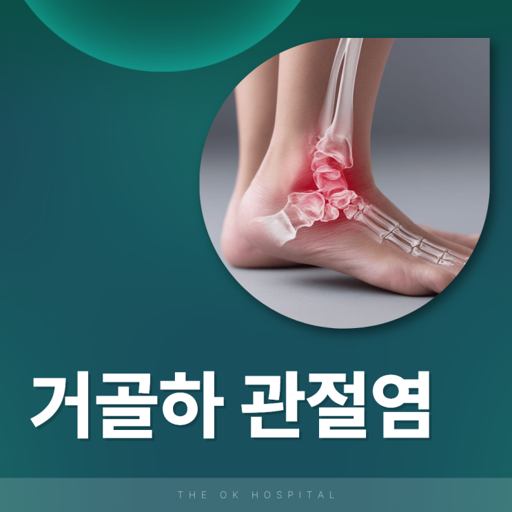  춘천 발목아래 통증 지속된다면 거골하관절염?