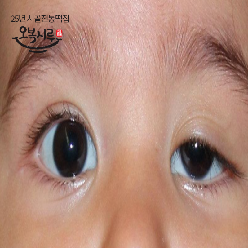 아기 안검하수, 크면 괜찮아질까?