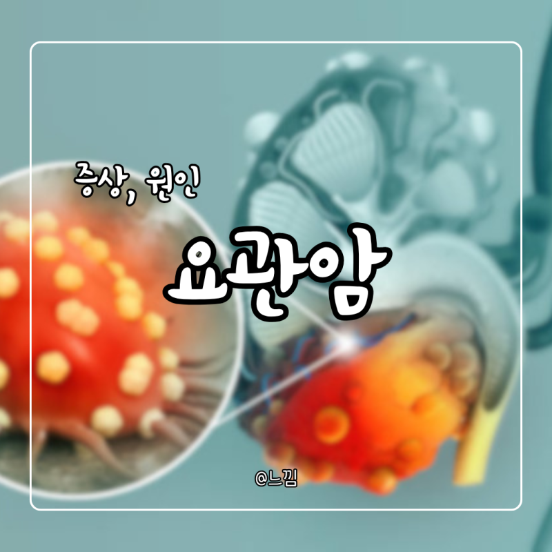 요관암 증상 요관암 3기 4기 전이 수술 생존율