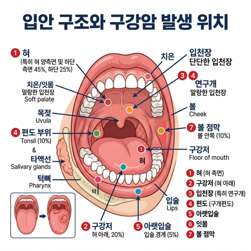 입안이 헐었는데 2주 넘게 안 낫는다면? 구강암 초기증상,원인,생존율 총정리