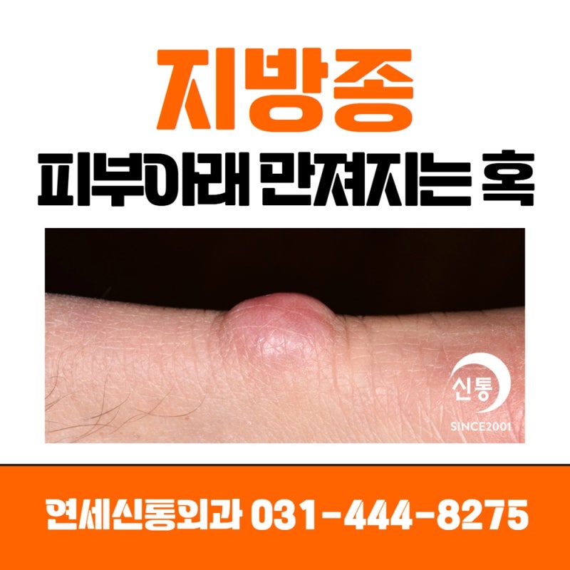 안양지방종제거 피부아래 만져지는 혹, 피하종양