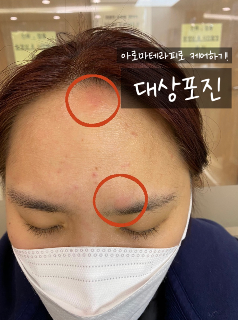 얼굴 대상포진 후기｜눈 통증·두통으로 입원했던 실제 경험 | 흉터 없이 회복환 관리기록