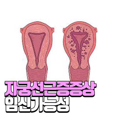 생리통인줄 알았던 자궁선근증 증상, 원인과 임신 가능여부