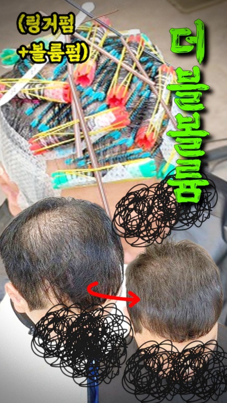  이천 탈모커버 잘하는 곳 찾는다면? 수원까지 찾아오는 40대 남성 링거펌 후기