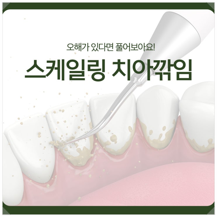  스케일링 치아깎임? 오해가 있다면 풀어보아요!