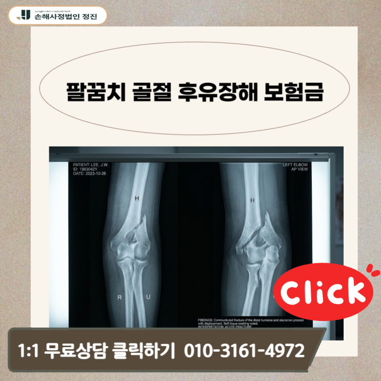  팔꿈치 골절 후유장해 보험금, 10명 중 8명이 놓치는 숨은 보상금 찾기