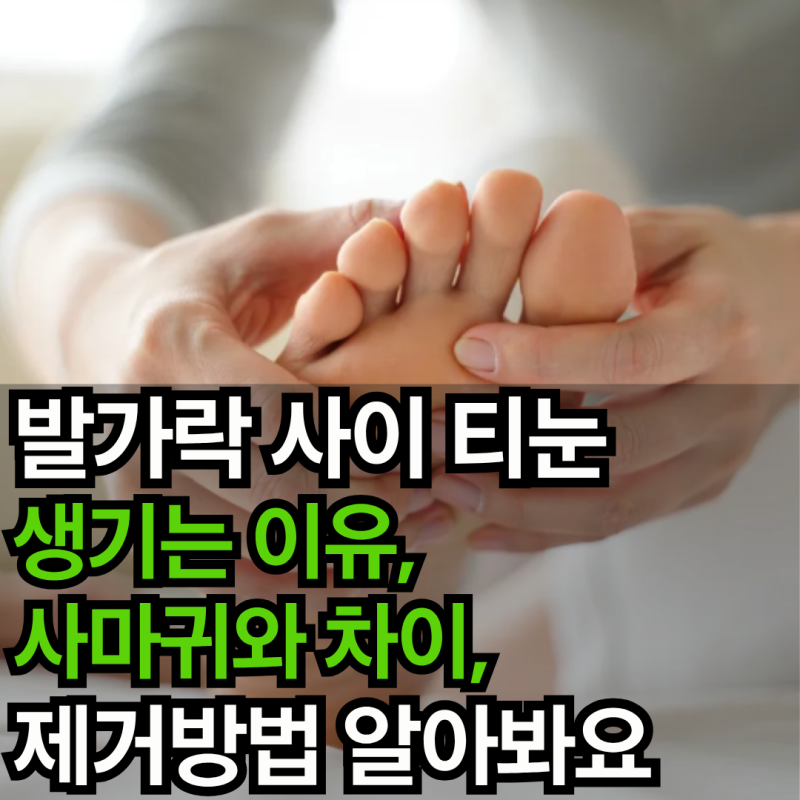 발가락 사이 티눈 생기는 이유, 사마귀와 차이, 제거방법 알아봐요