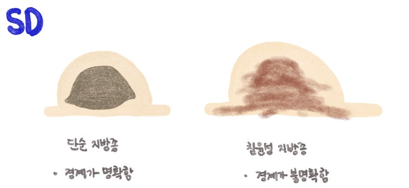 단순 지방종과 침윤성 지방종을 설명한 그림