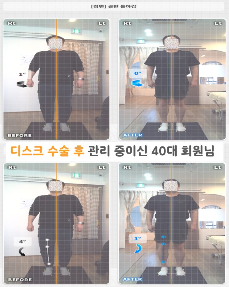  오산 세마역 필라테스디스크 수술   이후 무너진 자세 밸런스,                    40대 남성 회원님 변화 사례