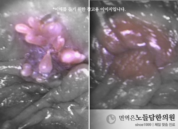 HPV 바이러스, 번호마다 증상이 다르다는 것 알고 계셨나요?