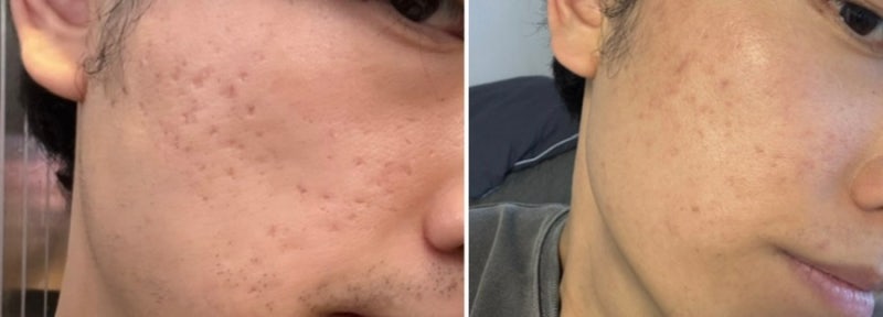 남자 여드름흉터 쥬베룩 서브시전 레이저 피부과 시술 가격 후기