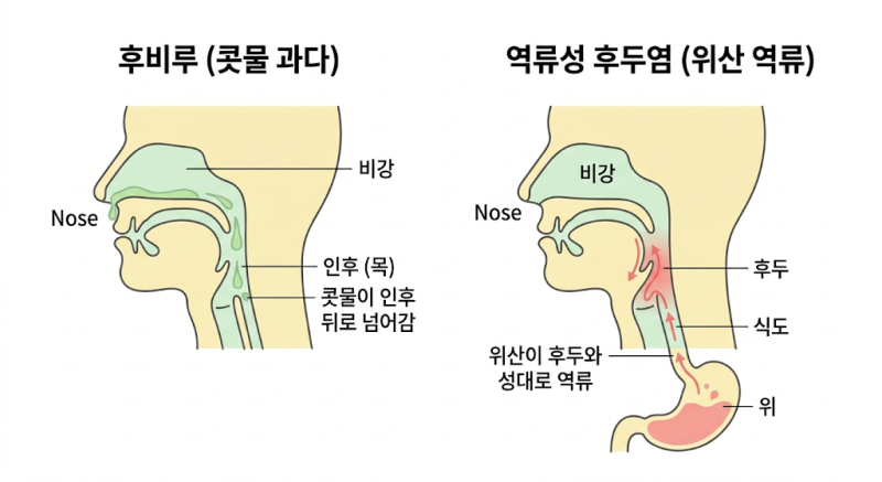 "목에 가래 낀 느낌, 감기약 먹어도 그대로라면?" 역류성후두염 의심해보세요. [처방전에 위....