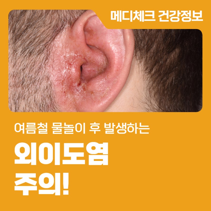 여름철 물놀이 후 발생하는 외이도염 주의!