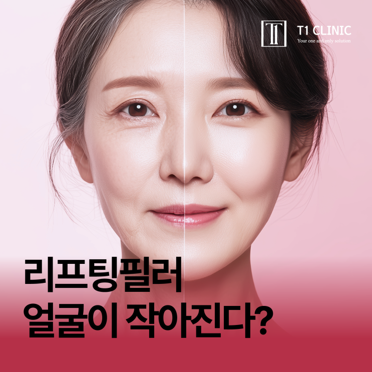  리프팅필러로 얼굴이 작아질 수 있다? 티원클리닉 대표원장이 알려주는 리프팅필러의 진실