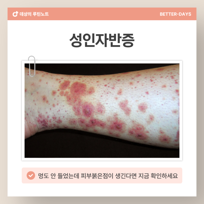 성인자반증 '이 신호' 4가지, 90%가 그냥 넘겼다가 후회합니다