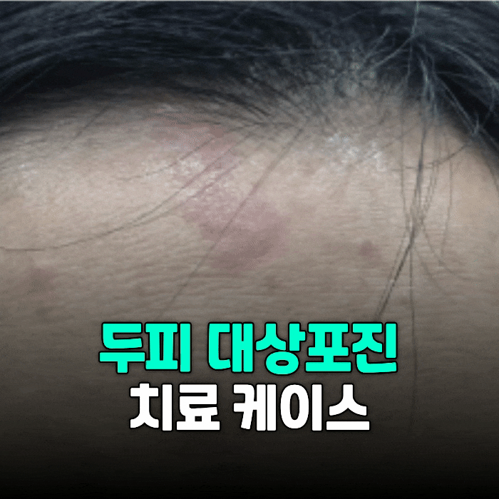 두피 대상포진, 신경통으로 이어지기 전 치료 시점이 중요합니다