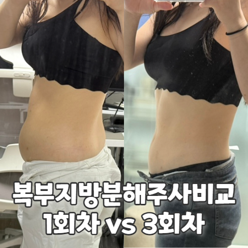  복부지방분해주사효과 얼마나 있을까? 1회차와 3회차 비교 리얼 후기
