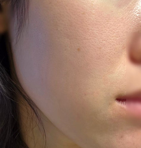 수란트라크림 부작용 없는 모낭염 3개월차 후기 (처방, 가격)