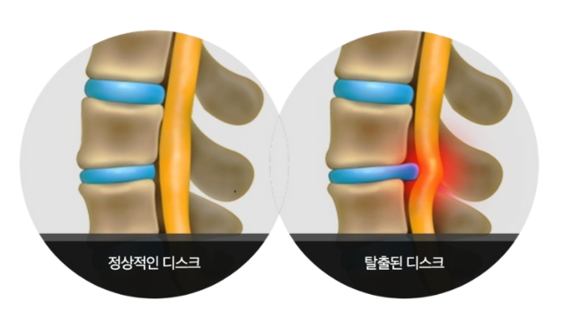 허리 디스크(추간판탈출증)의 정의와 증상, 치료방법(수술 및 신경차단술)