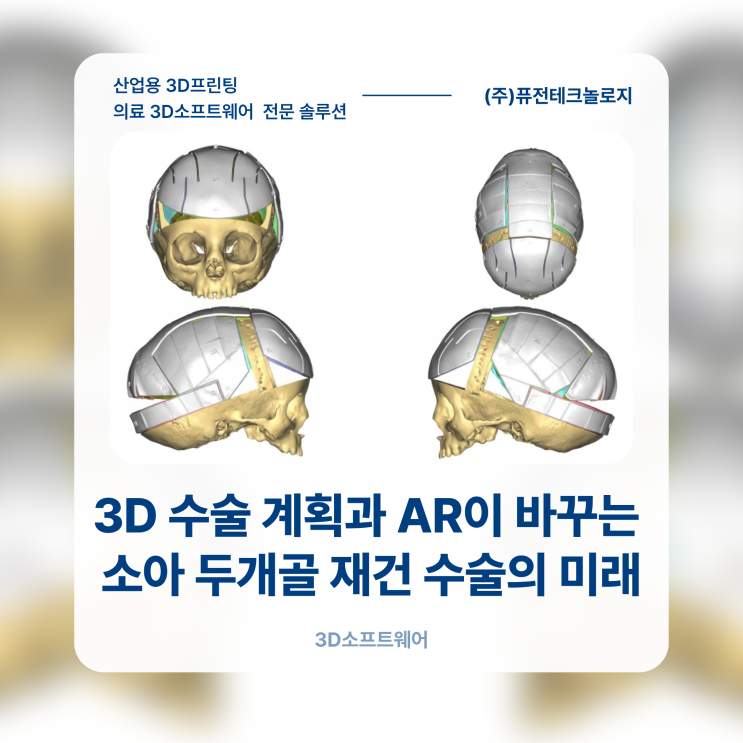 [Materialise S/W] 3D 수술 계획과 AR이 바꾸는 소아 두개골 재건 수술의 미래