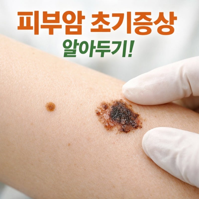 피부암 종류별 특징, 이것만 알면 조기 발견할 수 있습니다