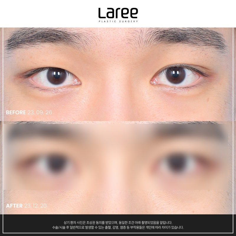 남자눈매교정 부담 없는 변화 나에게 맞는 디자인으로