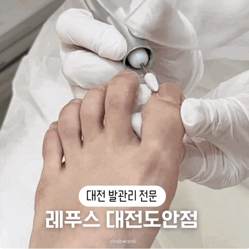 [대전발관리] 내성발톱 무좀발톱 전문 레푸스 대전도안점 발톱케어 스케일링 후기