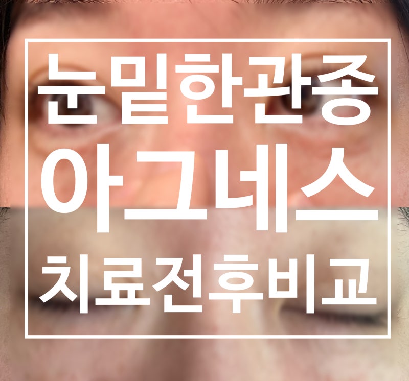 눈밑 한관종 아그네스 전후사진 찐후기 (통증,효과,관리법)
