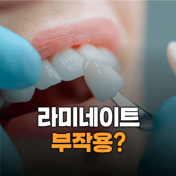  라미네이트 부작용, 후회하는 진짜 이유