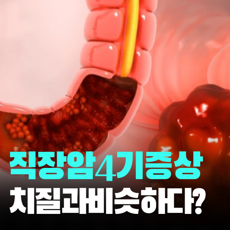 직장암 4기 증상과 치질 차이점 생존율