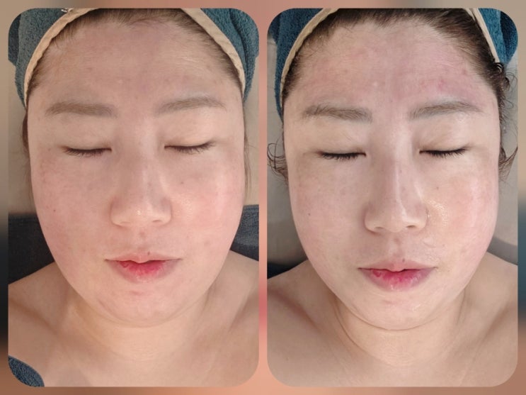  [진해]얼굴라인 정리 제대로 된 알테온 리프팅은 진해에스테틱 '카라코스메틱'