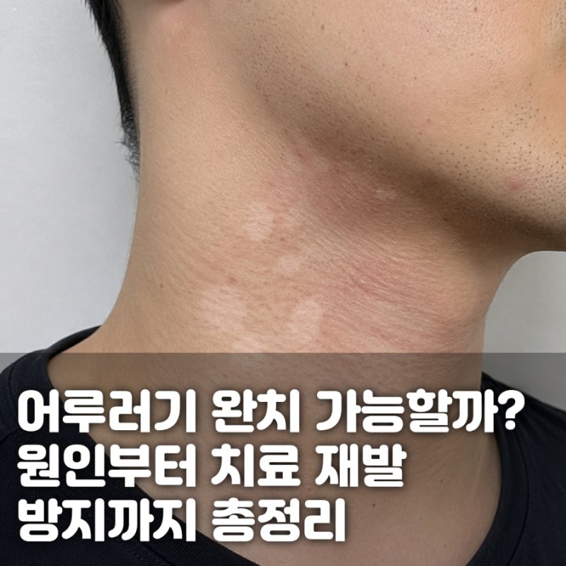 등·가슴에 얼룩 반점? 어루러기 원인, 치료·재발 방지까지 총정리