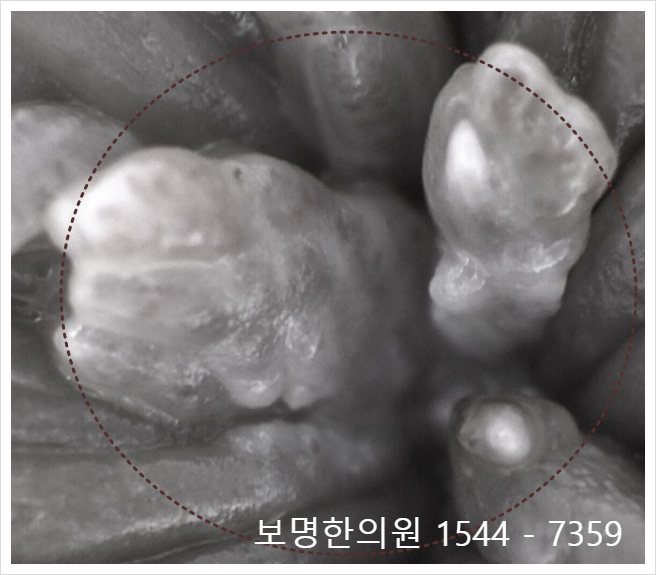 남성 콘딜로마 증상 초기 때 방치하면 안 되는 이유