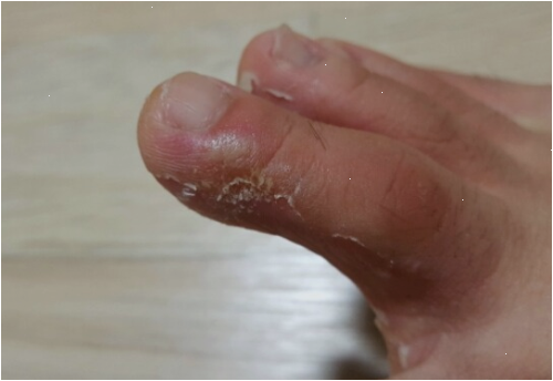발톱무좀 패치 추천 받아서 샀다가 깨달은 부분
