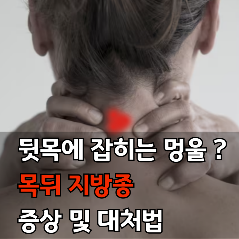뒷목에 잡히는 멍울의 정체! 목뒤지방종 증상과 대처법 알려드릴게요