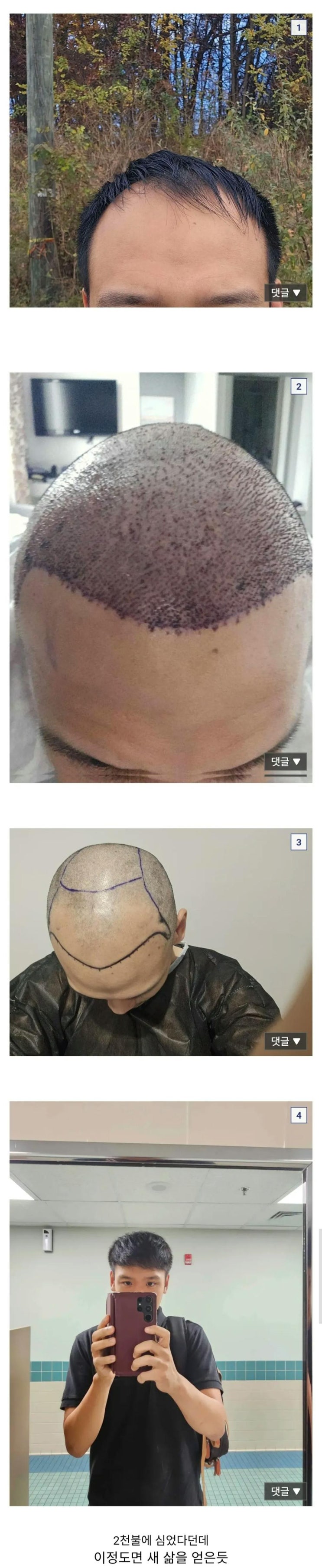  터키에서 모발이식 8천모 받은 디시인 후기.jpg