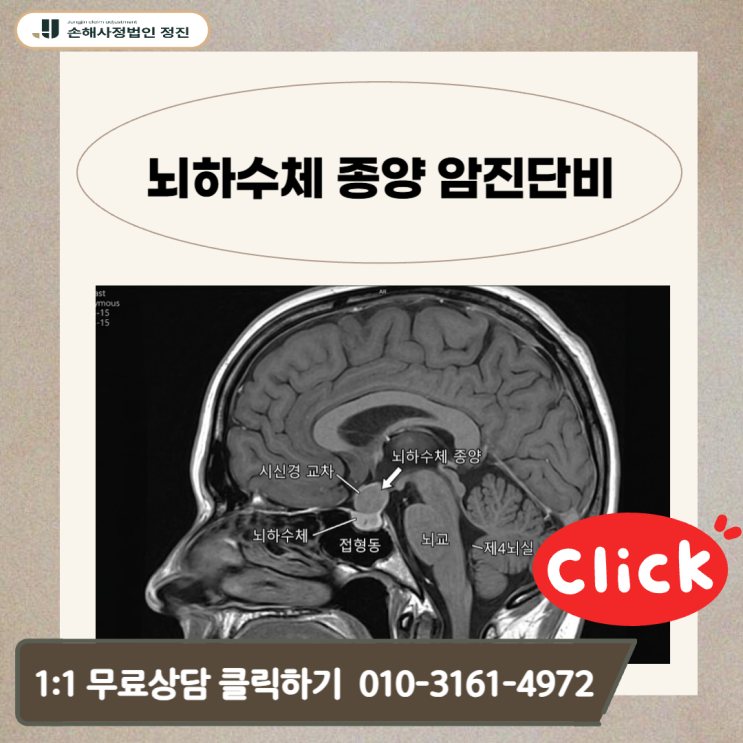  뇌하수체 종양 암진단비, D35.2 코드인데도 일반암 100% 인정받은 실무 사례