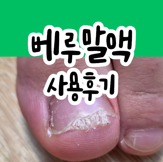 사마귀 치료제 베루말액 사용 후기