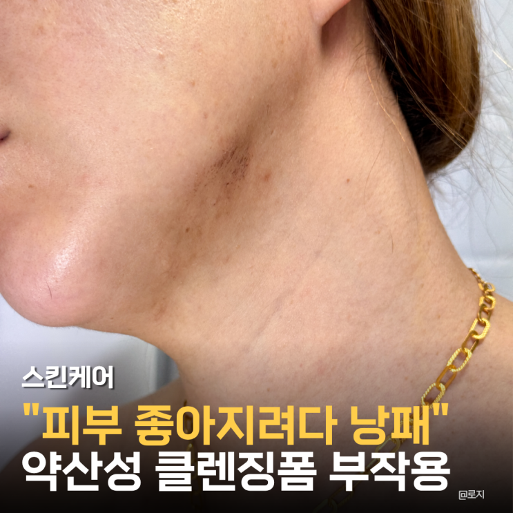  올리브영 폼클렌저 바하 약산성 클렌징폼 사용 후 부작용