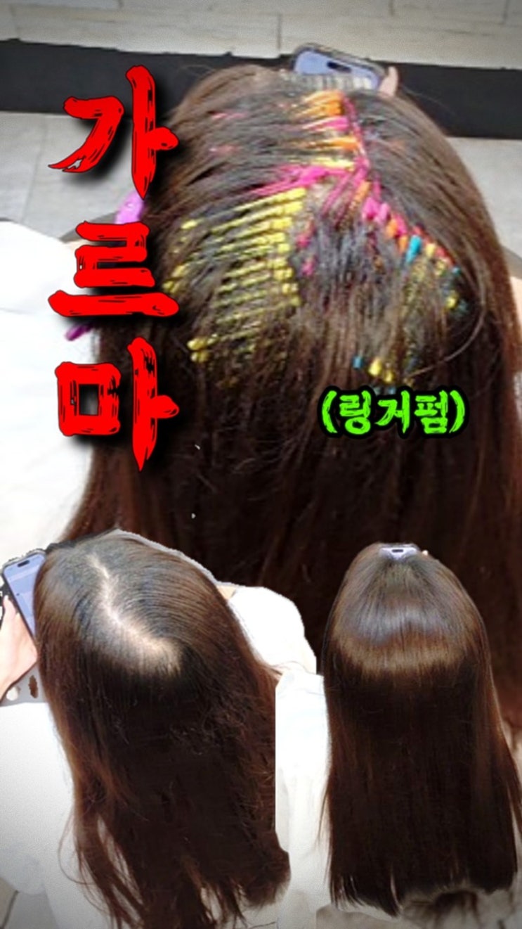  구로 모류교정 잘하는 곳 찾다가 수원까지? 뒤통수 갈라짐 링거펌 리얼 후기