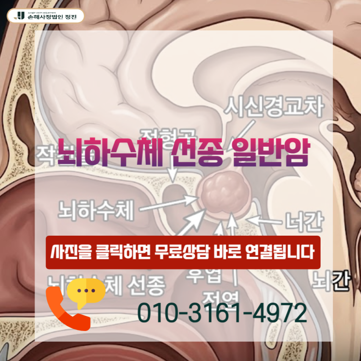  뇌하수체 선종 일반암, D35.2 코드라도 8천만 원 전액 받아낸 비법은?