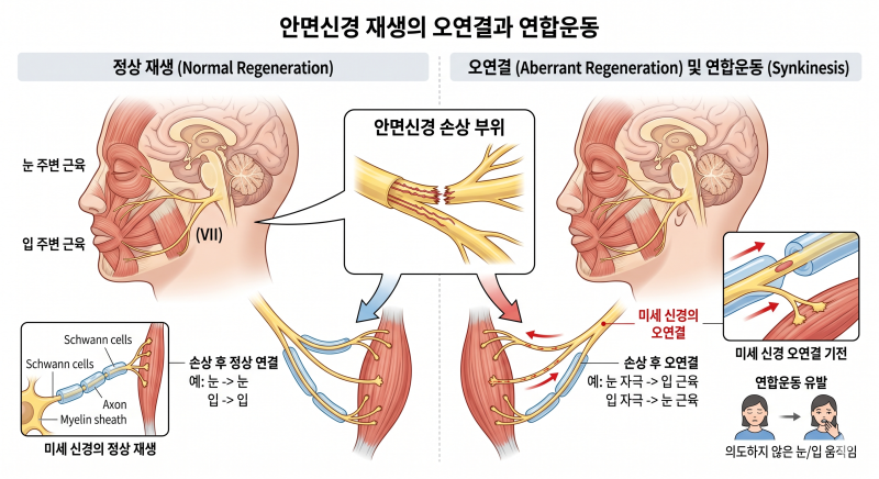 [강서구 화곡역 안면마비] 연합운동 눈떨림, '이 치료'가 반드시 필요한 과학적 이유