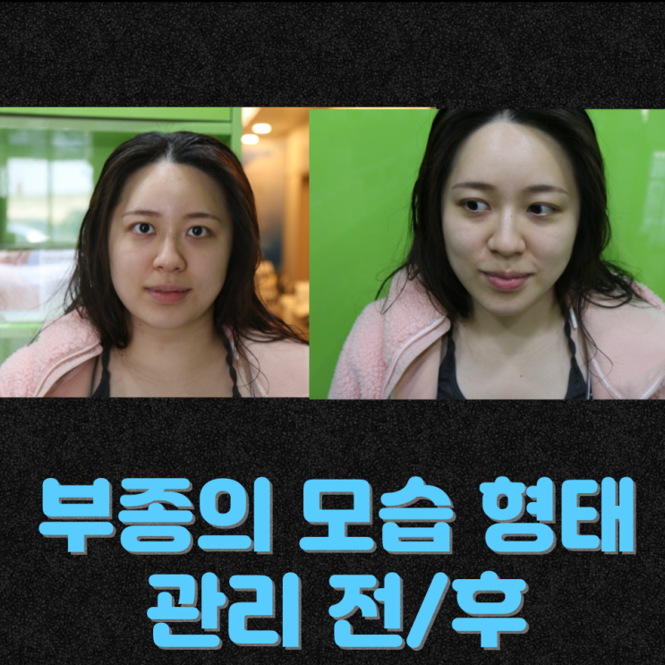  천안 신부동 산후관리, 몸이 부어 보이는 건 살이 찐 걸까요?(산후부종관리)