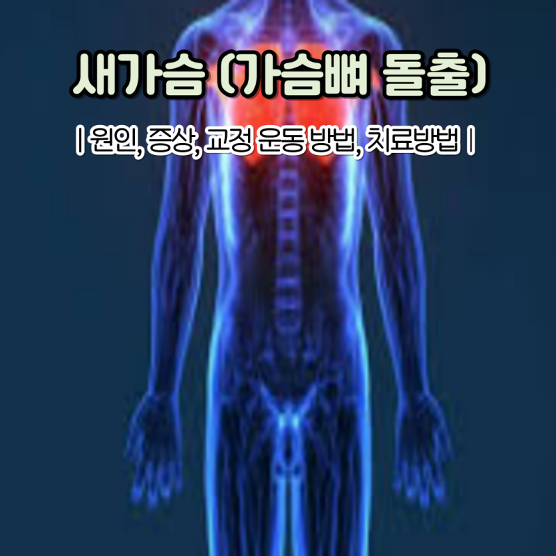 가슴뼈 돌출 새가슴 모양 원인 새가슴 교정 운동 방법은?