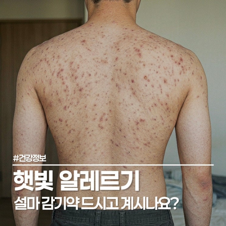  햇빛 알레르기 증상 딱 이 느낌, 요즘 가려워 미치겠다면?